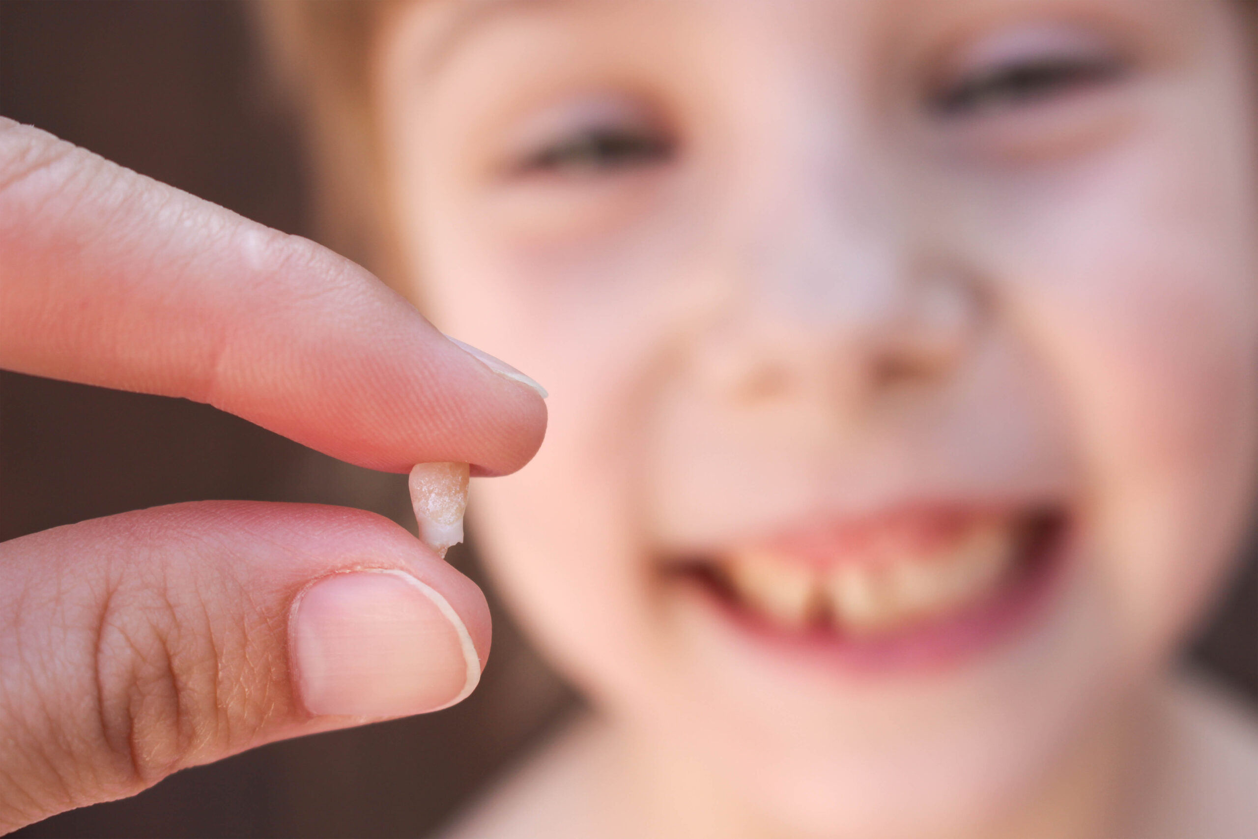 Tooth Extractions Irving