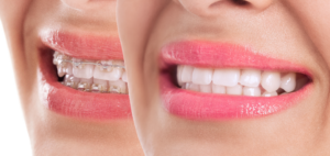 before and after braces